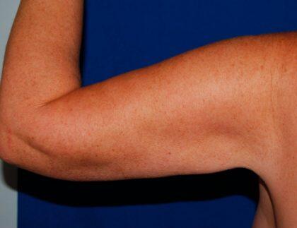 Minimal Incision Arm Lift Before & After Image