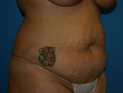 Share 79 about tummy tuck scar tattoo super cool  indaotaonec