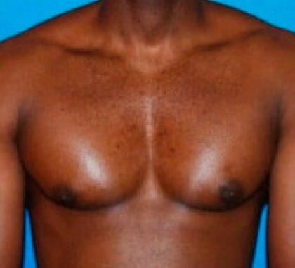 Is Breast Reduction Worth It?, Boca Raton