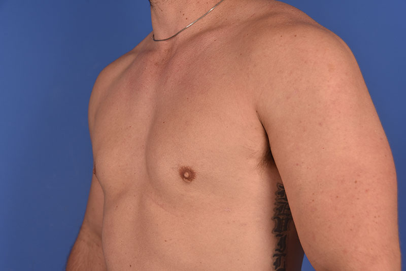 Gynecomastia Before & After Image