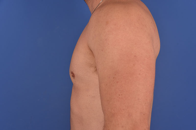 Gynecomastia Before & After Image