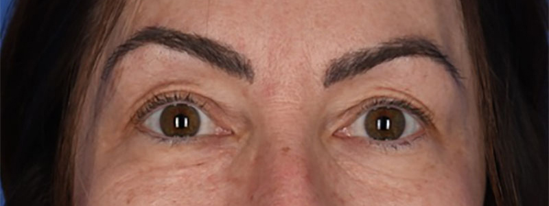 Blepharoplasty Before & After Image