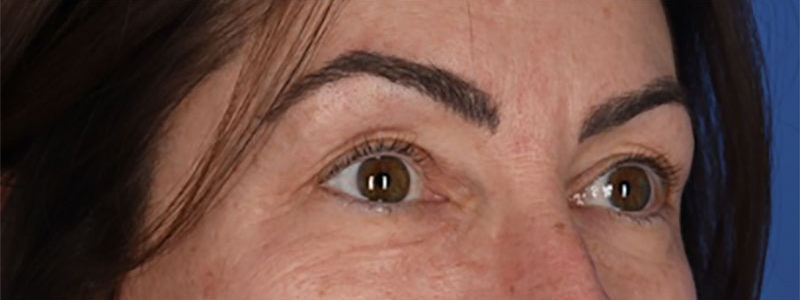 Blepharoplasty Before & After Image