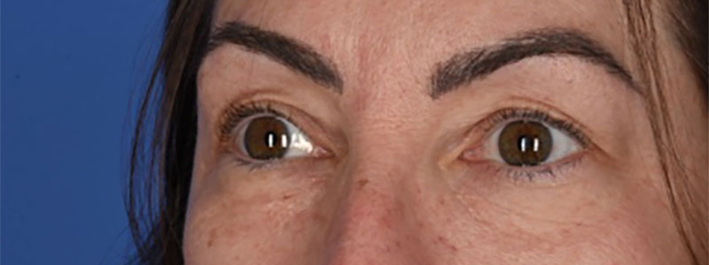 Blepharoplasty Before & After Image