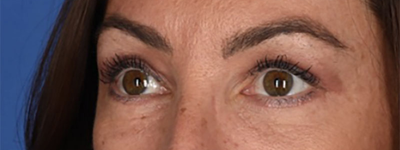 Blepharoplasty Before & After Image