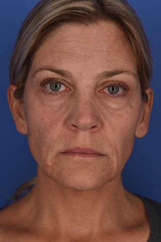 Endoscopic Mid Facelift Before & After Image