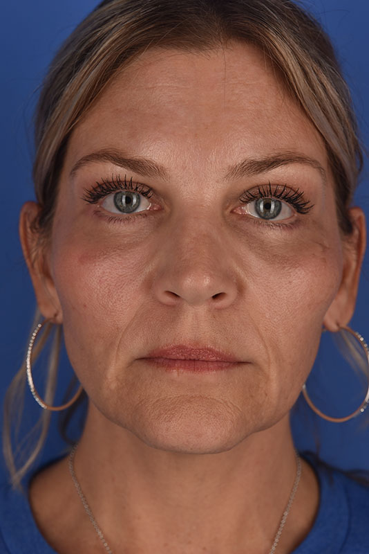 Endoscopic Mid Facelift Before & After Image