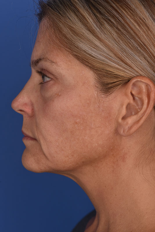 Endoscopic Mid Facelift Before & After Image