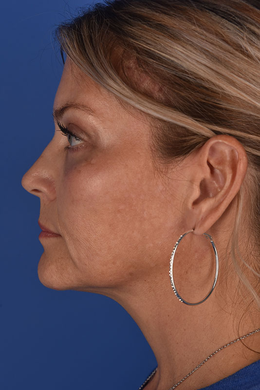 Endoscopic Mid Facelift Before & After Image