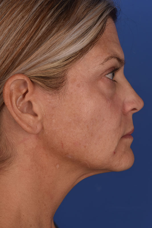 Endoscopic Mid Facelift Before & After Image