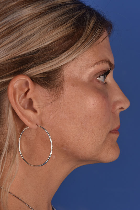 Endoscopic Mid Facelift Before & After Image