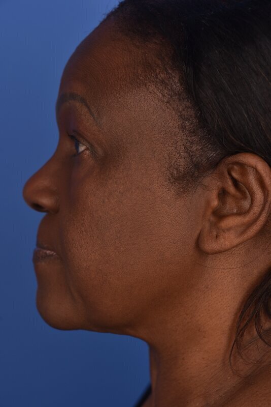 Endoscopic Mid Facelift Before & After Image