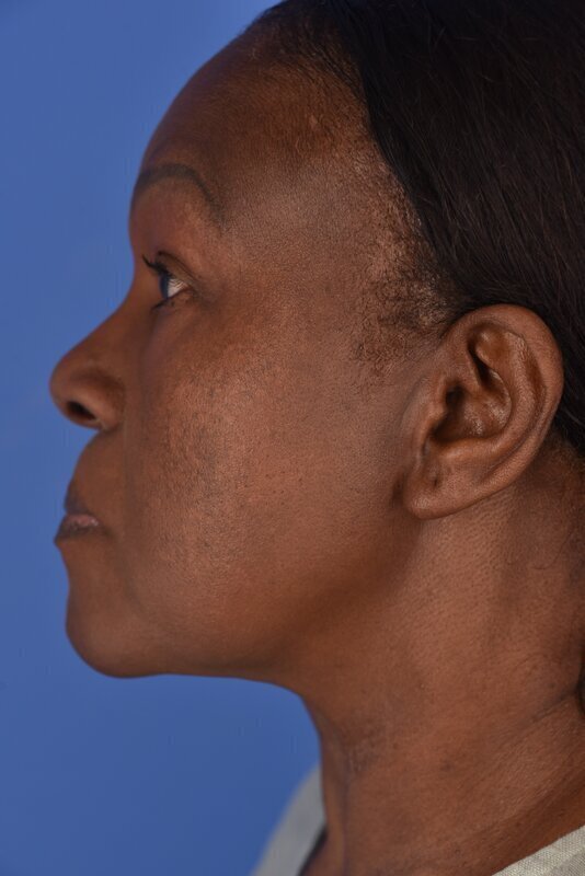 Endoscopic Mid Facelift Before & After Image