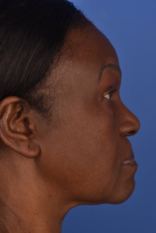 Endoscopic Mid Facelift Before & After Image