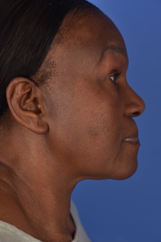 Endoscopic Mid Facelift Before & After Image