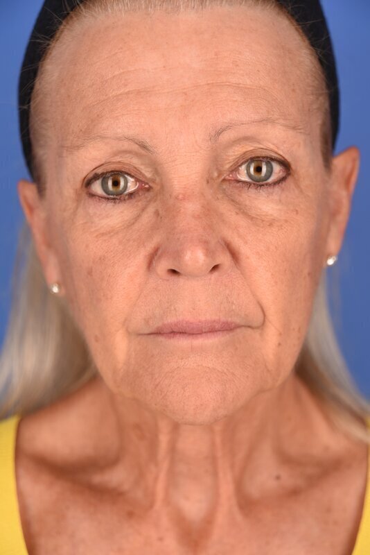 Endoscopic Mid Facelift Before & After Image