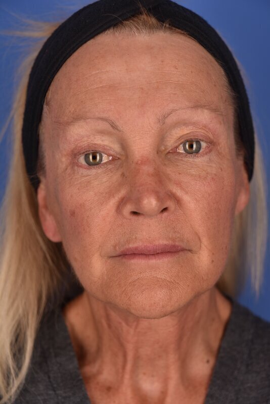 Endoscopic Mid Facelift Before & After Image