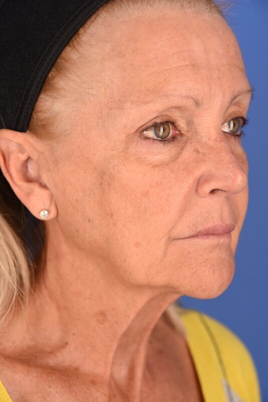 Endoscopic Mid Facelift Before & After Image