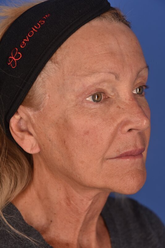 Endoscopic Mid Facelift Before & After Image