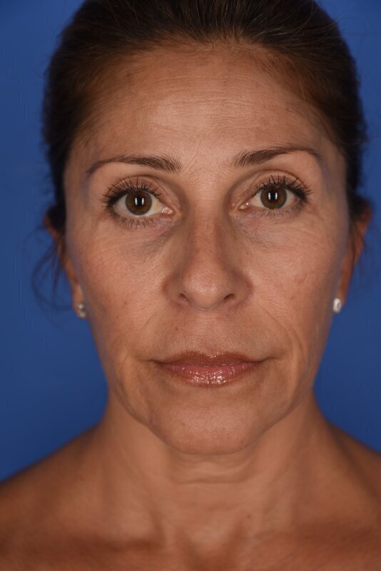 Endoscopic Mid Facelift Before & After Image