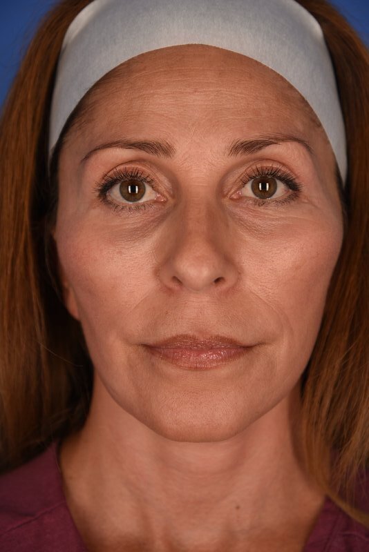 Endoscopic Mid Facelift Before & After Image