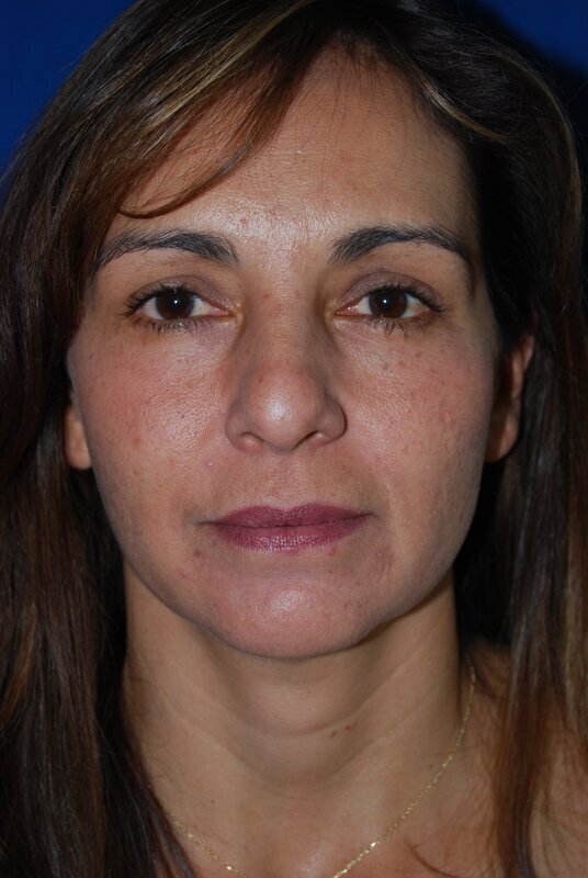 Endoscopic Mid Facelift Before & After Image