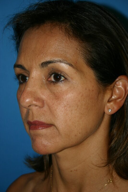 Endoscopic Mid Facelift Before & After Image