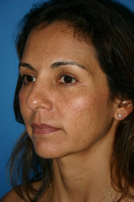 Endoscopic Mid Facelift Before & After Image