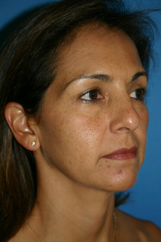 Endoscopic Mid Facelift Before & After Image