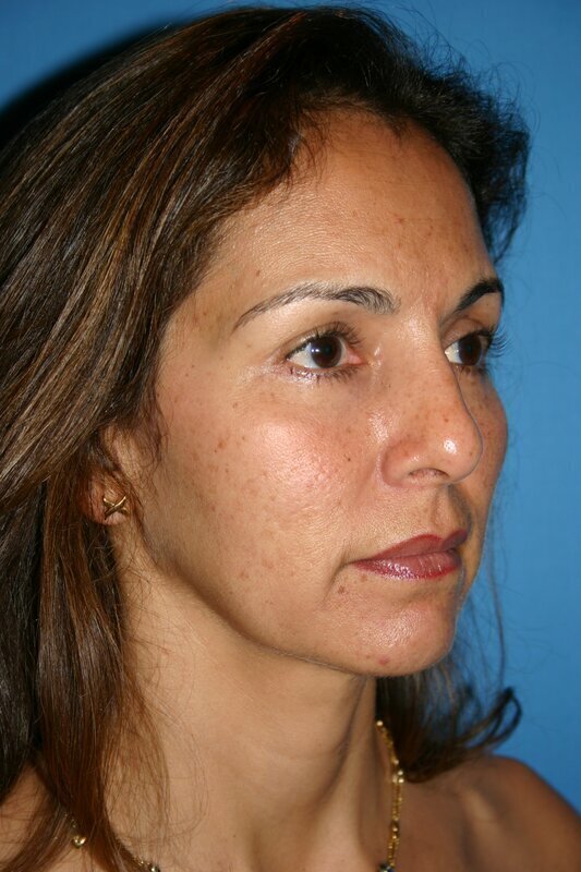 Endoscopic Mid Facelift Before & After Image