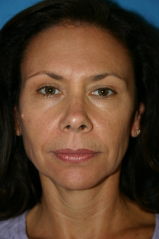 Endoscopic Mid Facelift Before & After Image