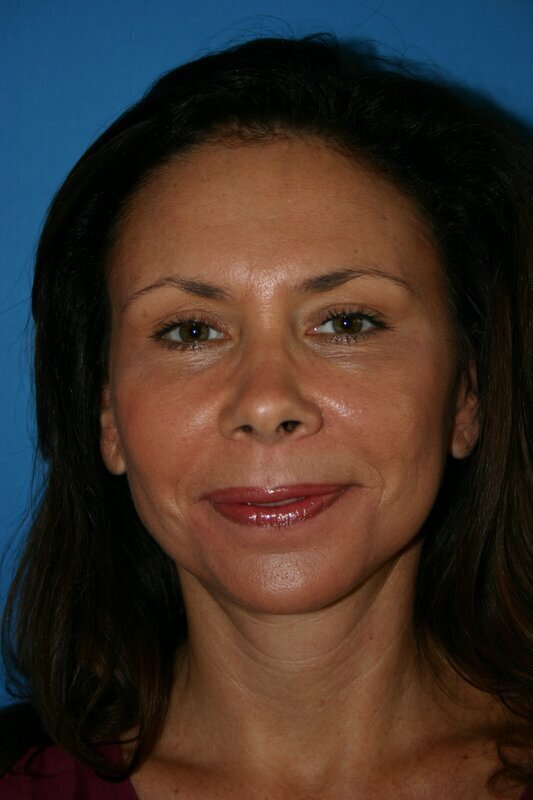 Endoscopic Mid Facelift Before & After Image