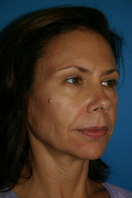 Endoscopic Mid Facelift Before & After Image