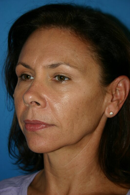 Endoscopic Mid Facelift Before & After Image