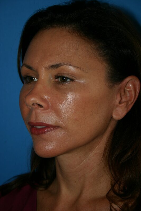 Endoscopic Mid Facelift Before & After Image