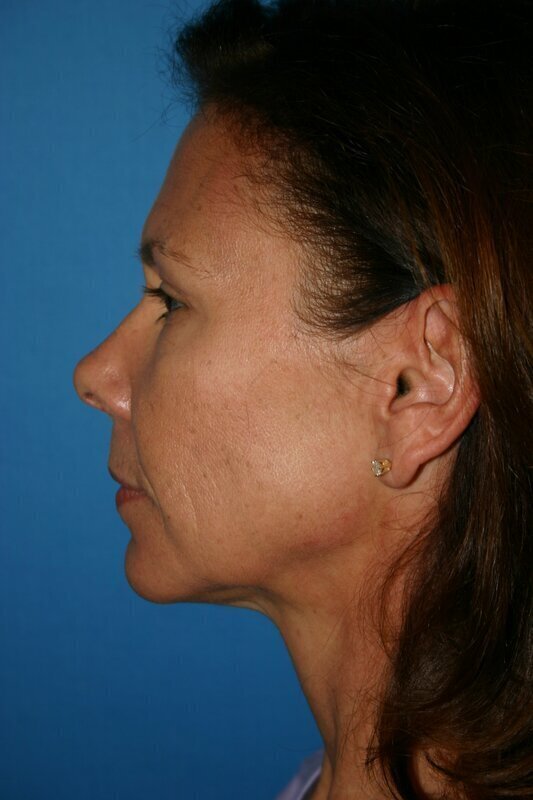 Endoscopic Mid Facelift Before & After Image