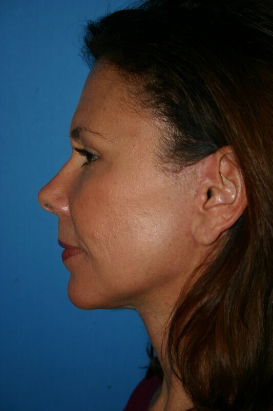 Endoscopic Mid Facelift Before & After Image