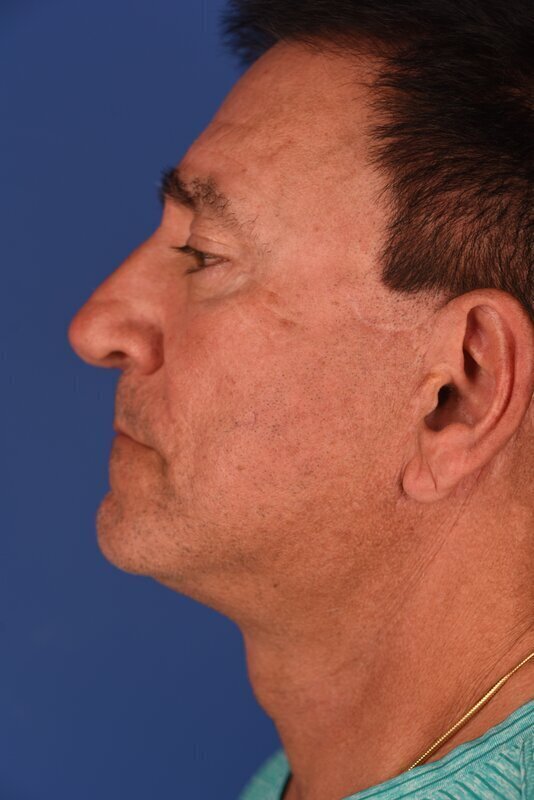 Endoscopic Mid Facelift Before & After Image