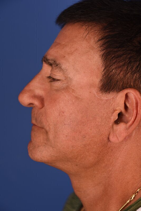 Endoscopic Mid Facelift Before & After Image