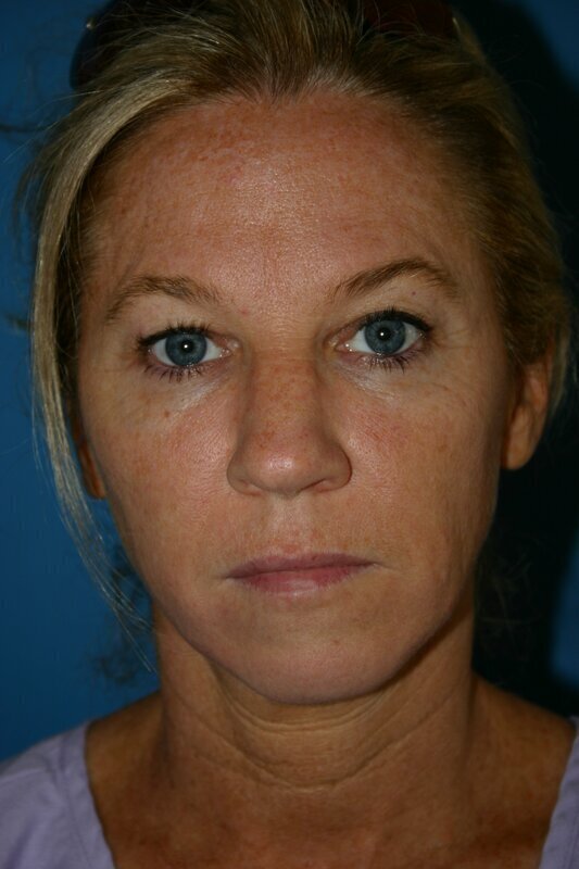 Endoscopic Mid Facelift Before & After Image