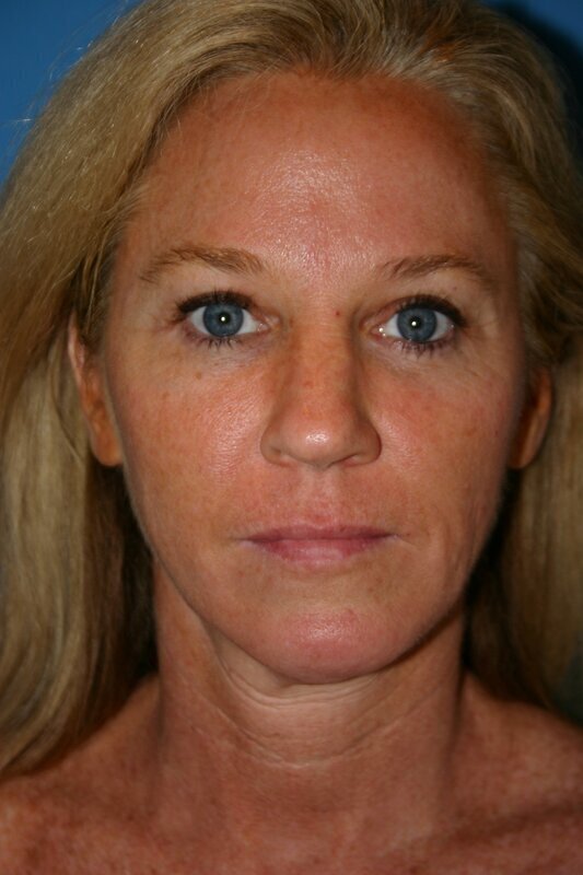 Endoscopic Mid Facelift Before & After Image