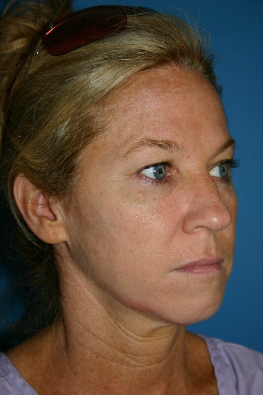 Endoscopic Mid Facelift Before & After Image