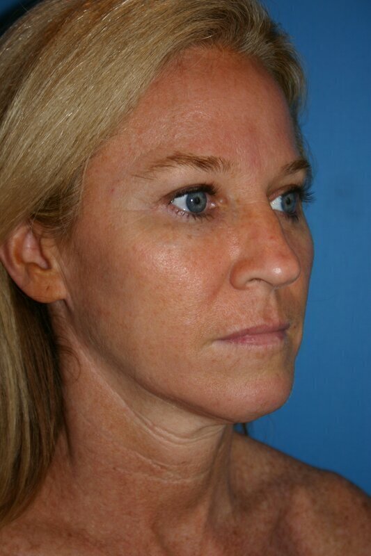 Endoscopic Mid Facelift Before & After Image