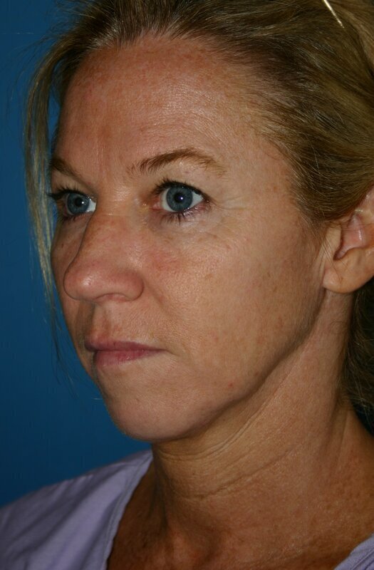 Endoscopic Mid Facelift Before & After Image