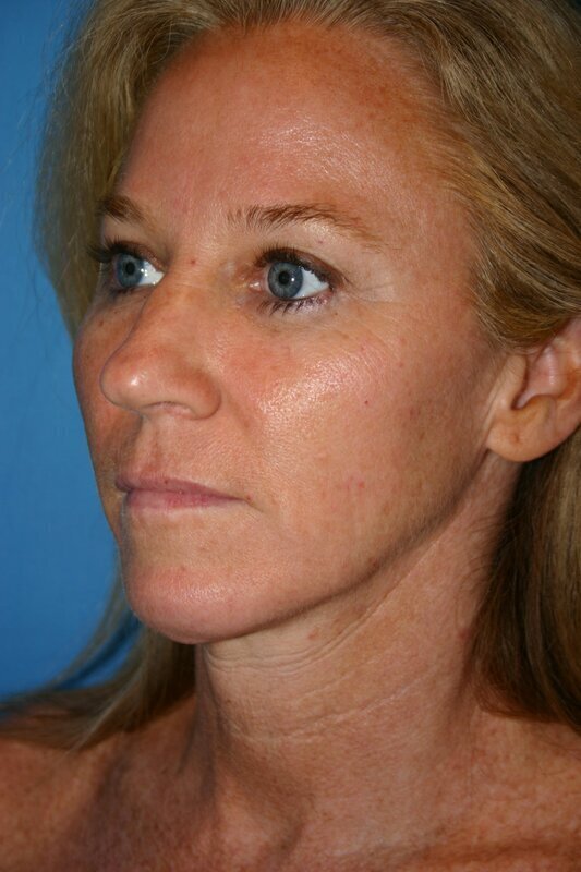 Endoscopic Mid Facelift Before & After Image