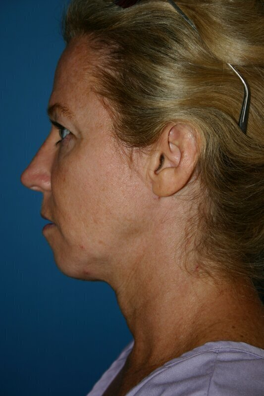 Endoscopic Mid Facelift Before & After Image