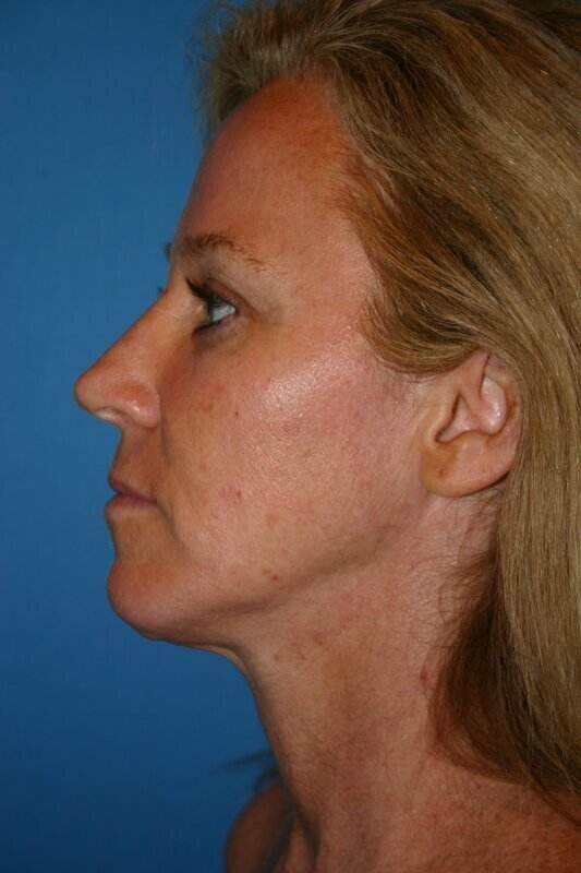 Endoscopic Mid Facelift Before & After Image